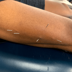 Dry Needling Chandler Physical Therapy